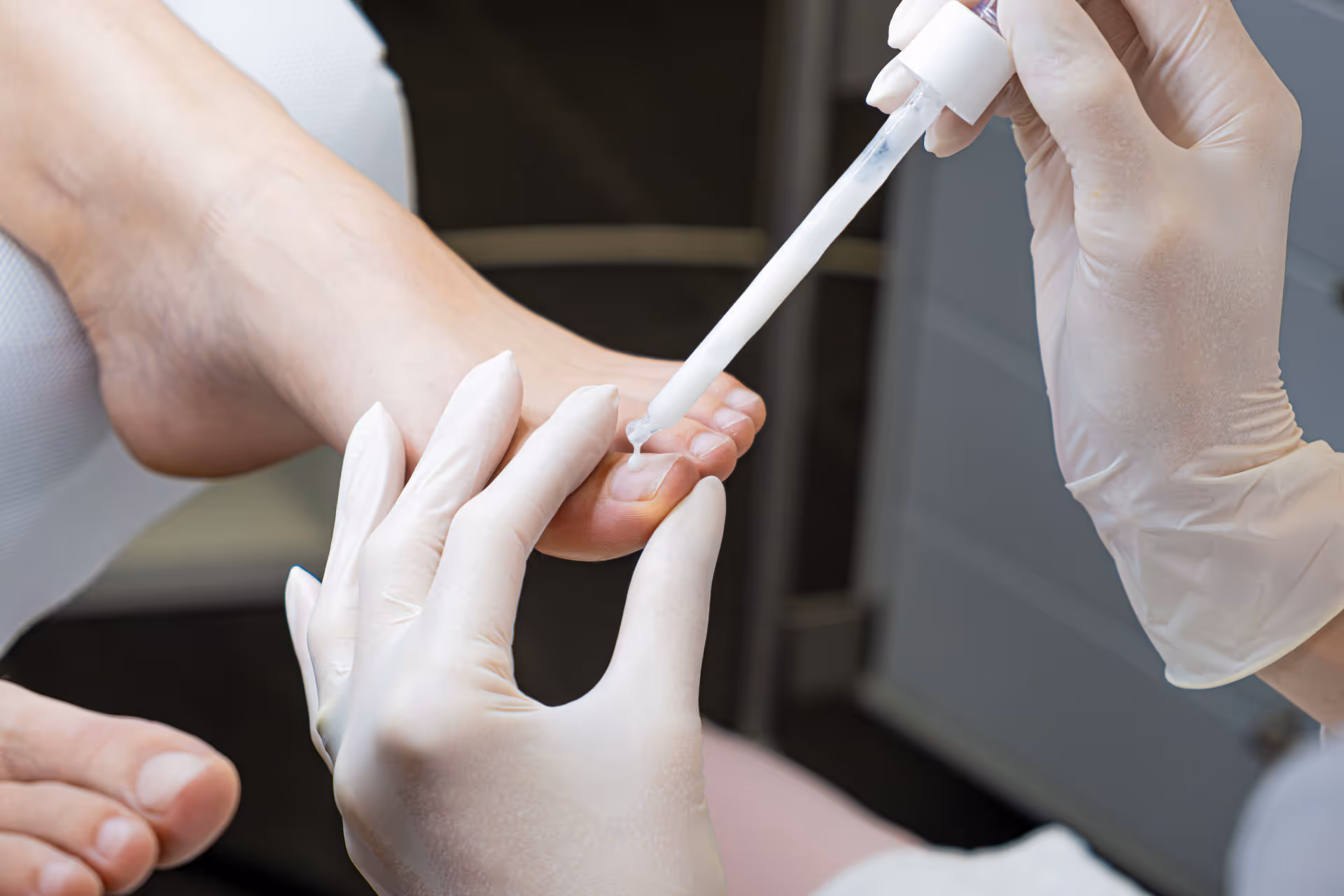 Podologe trägt mit einer Pipette Flüssigkeit auf den großen Zeh eines Fußes auf und trägt dabei weiße Handschuhe.