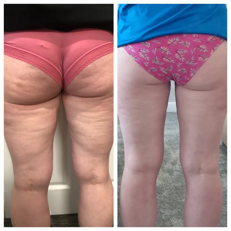 Alina 48, 5 Monate Anwendung