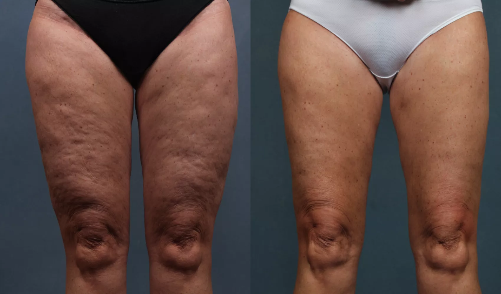 Heike 38, 6 Monate Anwendung