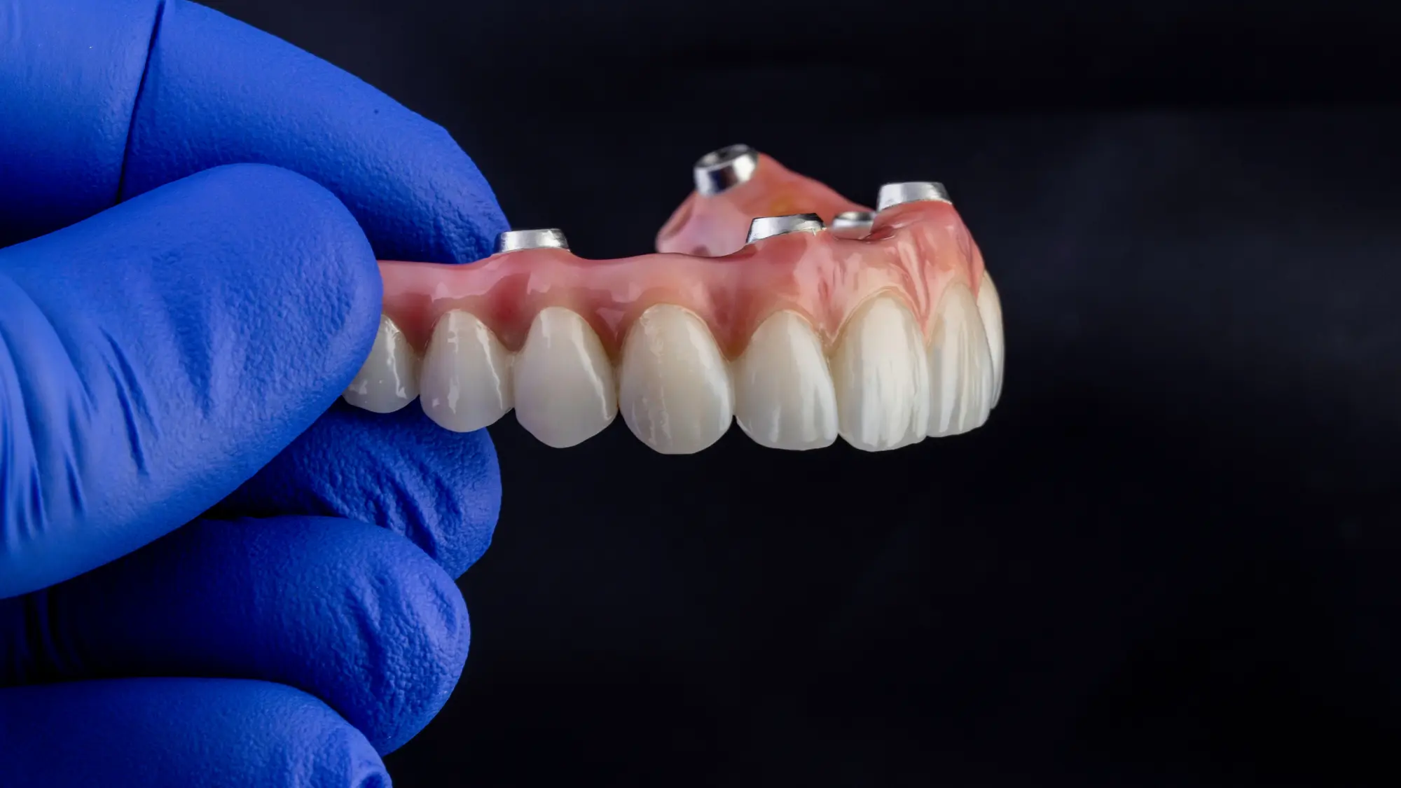 Full Mouth Rehab