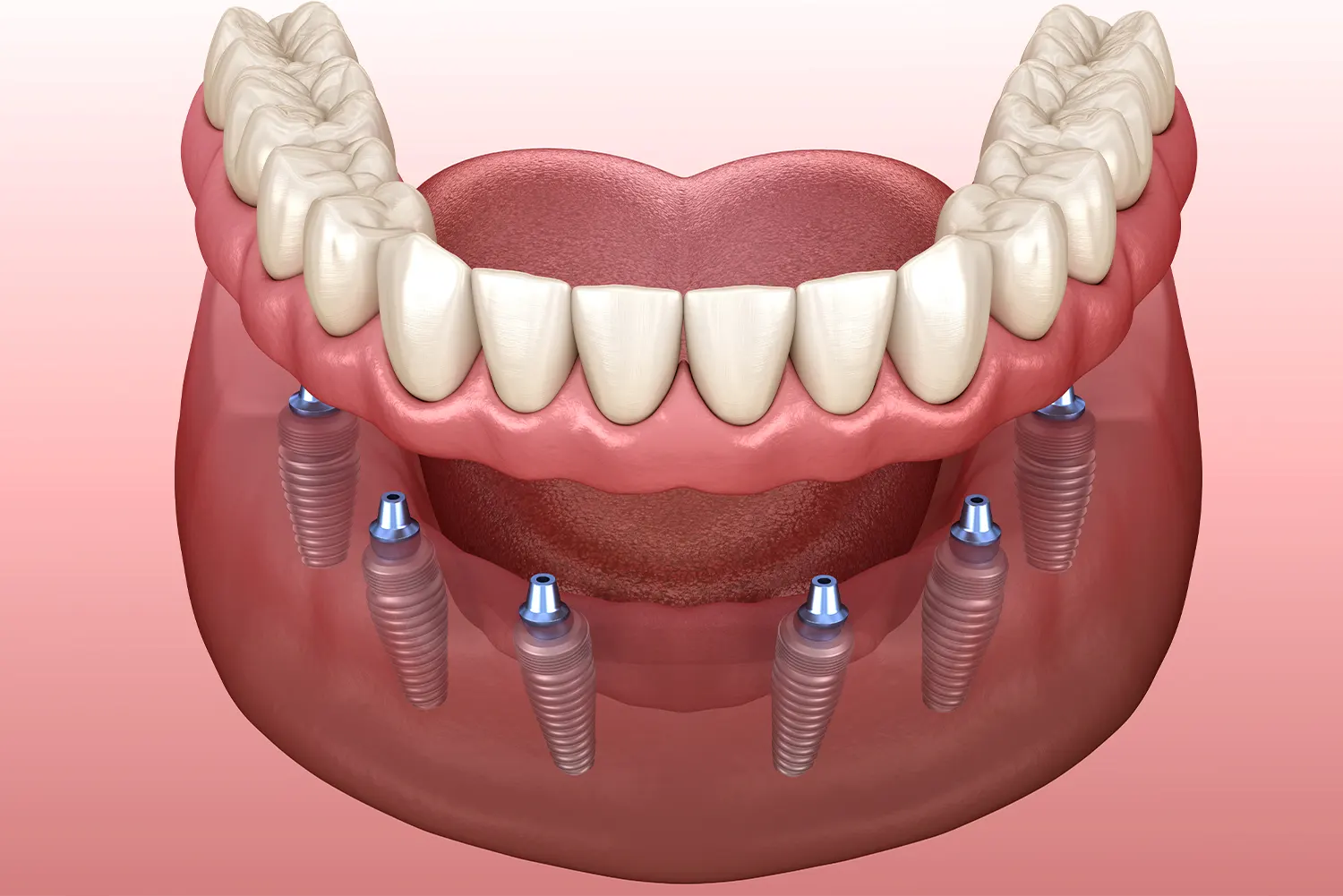 All-on-X Dental Implants in Las Vegas, NV | Express Dental Studio