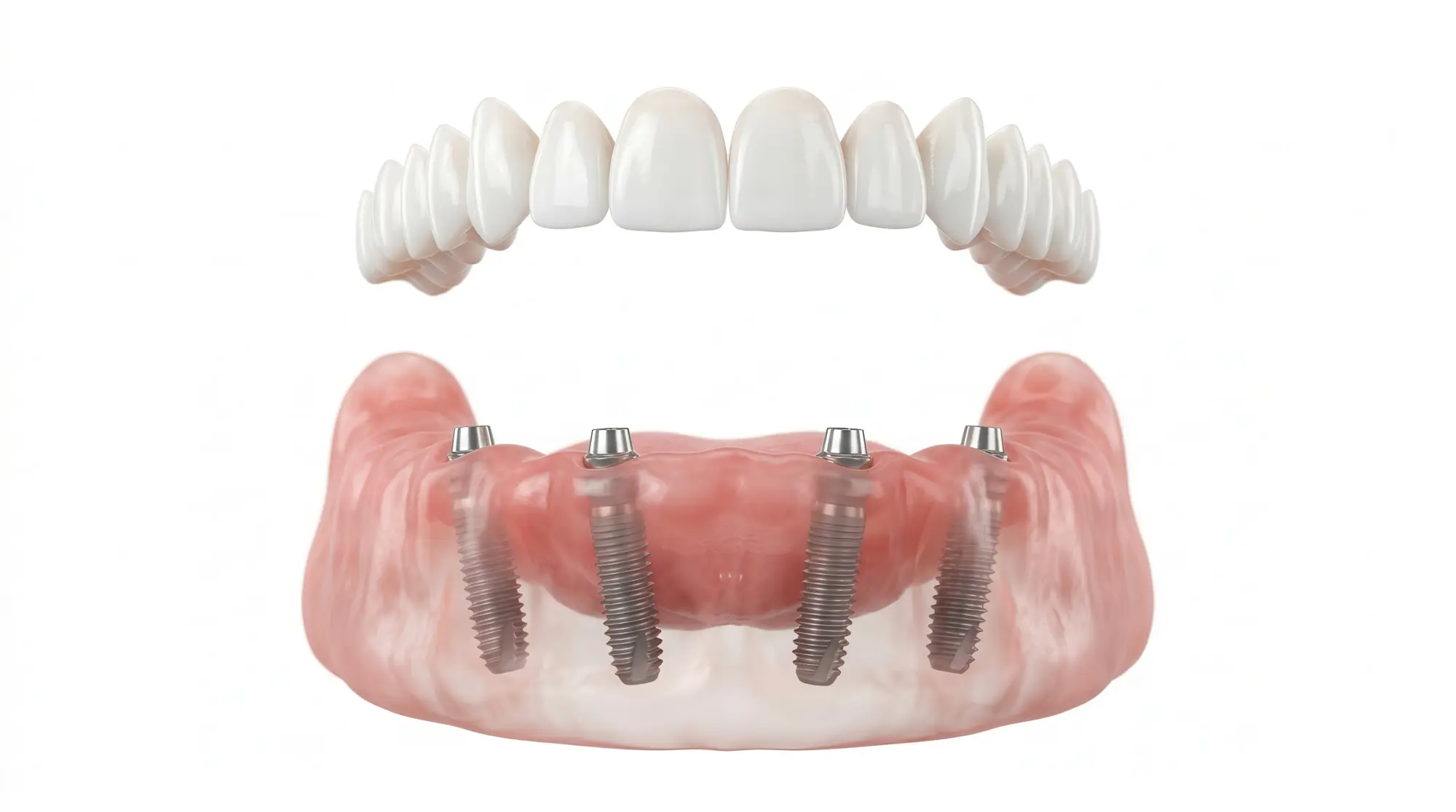 All-on-X Dental Implants in Las Vegas, NV | Express Dental Studio