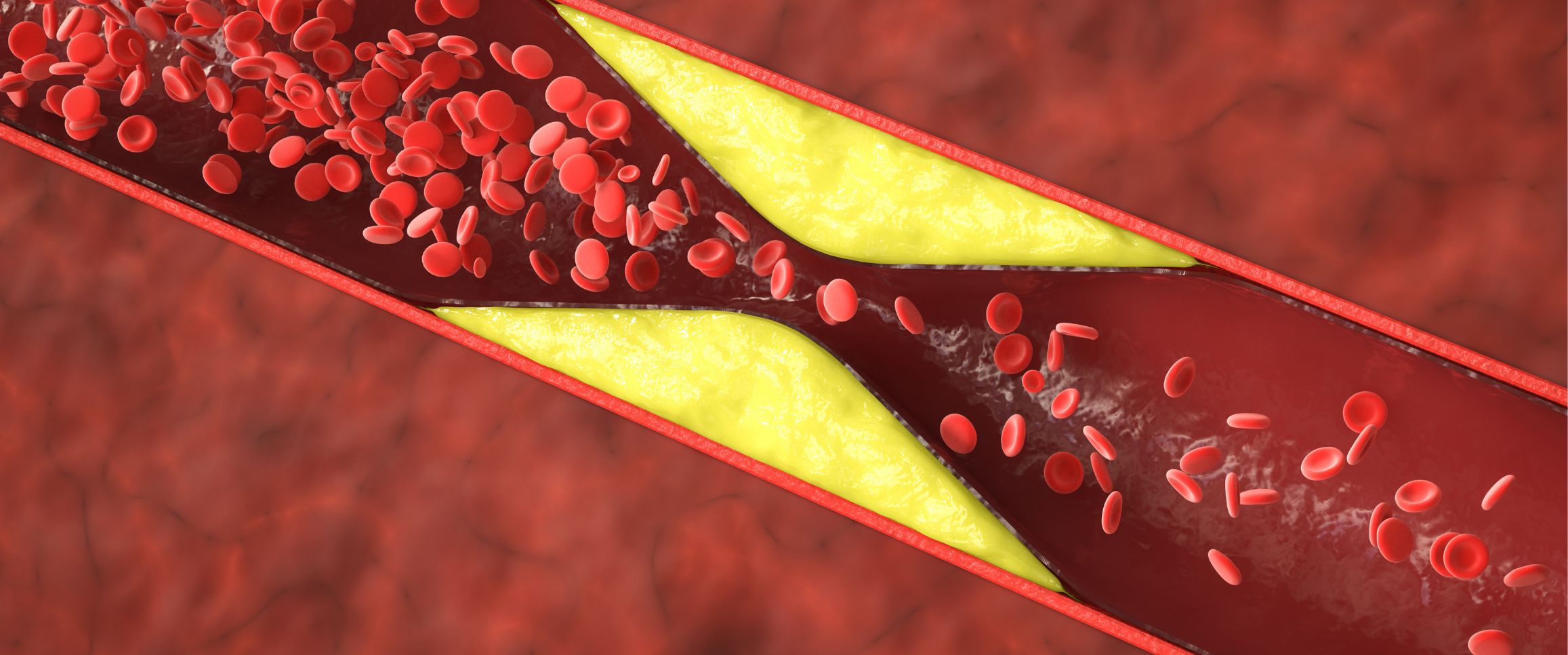 Can High Cholesterol Cause Erectile Dysfunction?