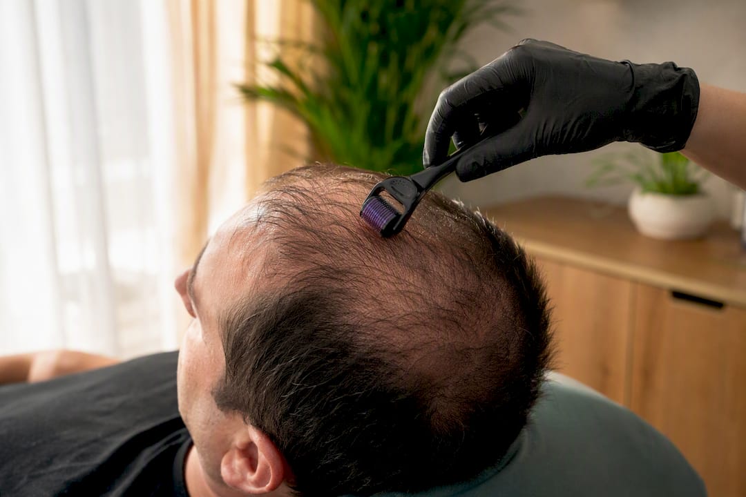 Microneedling device rolling on scalp skin