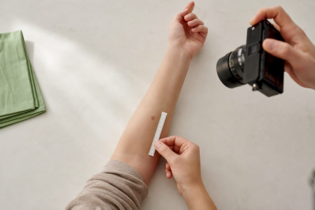 Patient photographing skin lesion with ruler