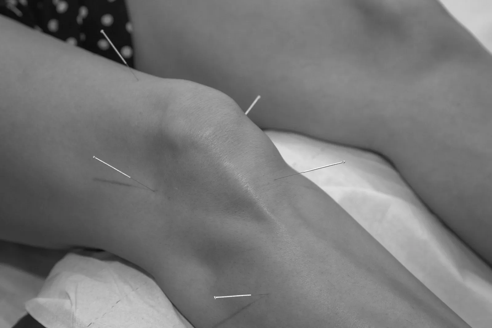 acupuncture needles being put in a patient's knee