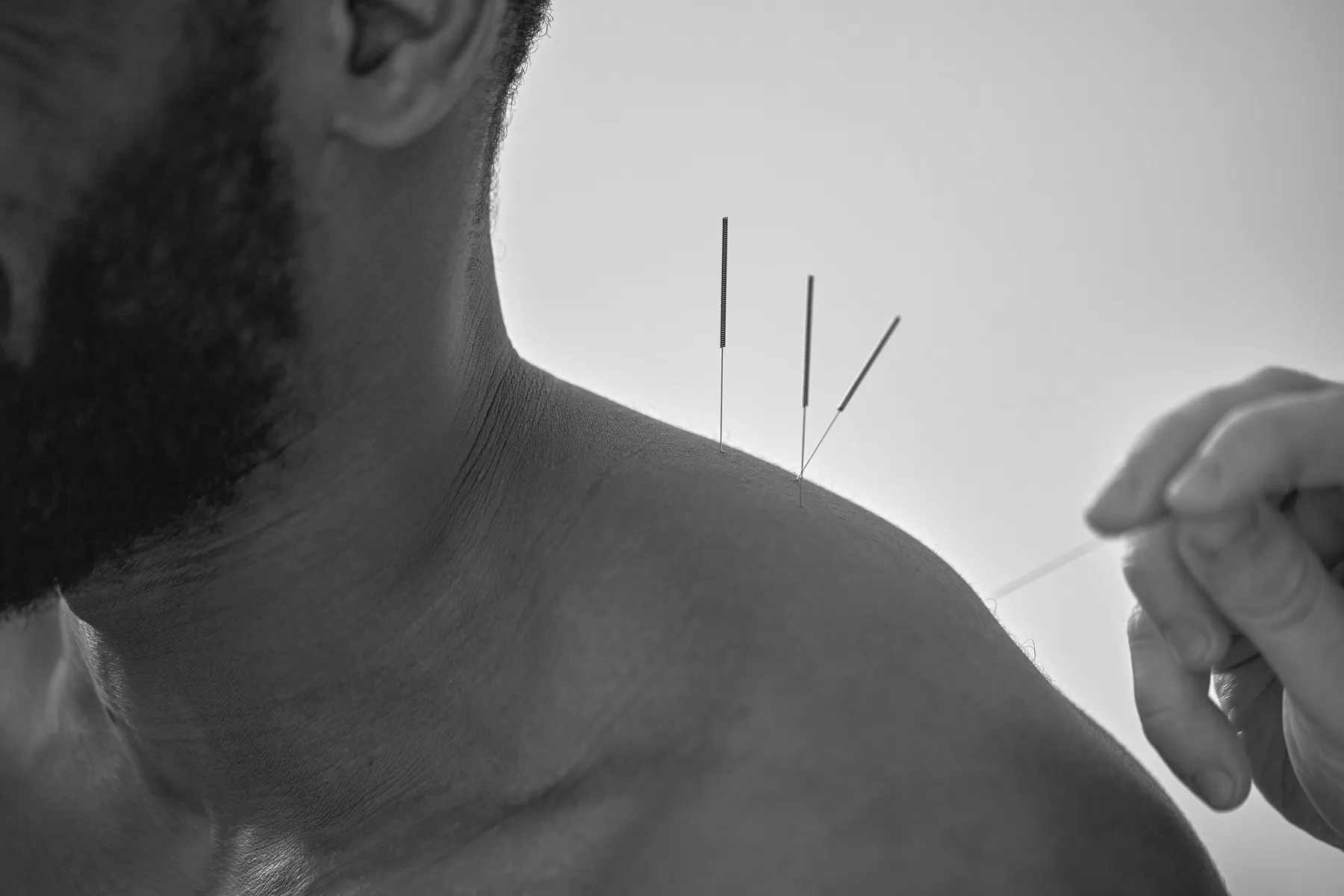 acupuncture needles being put in a patient's back