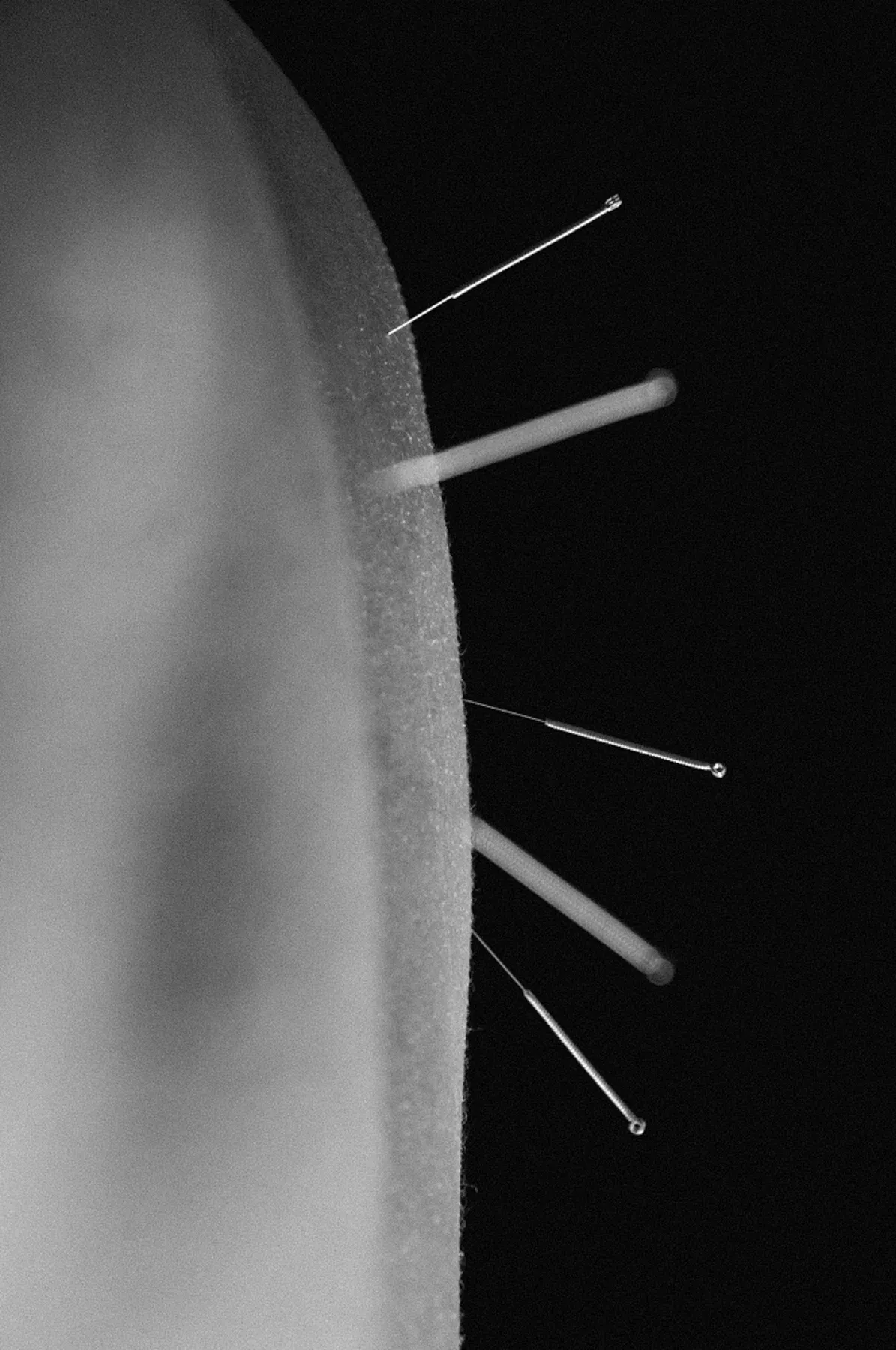 acupuncture needles set in a patient's back