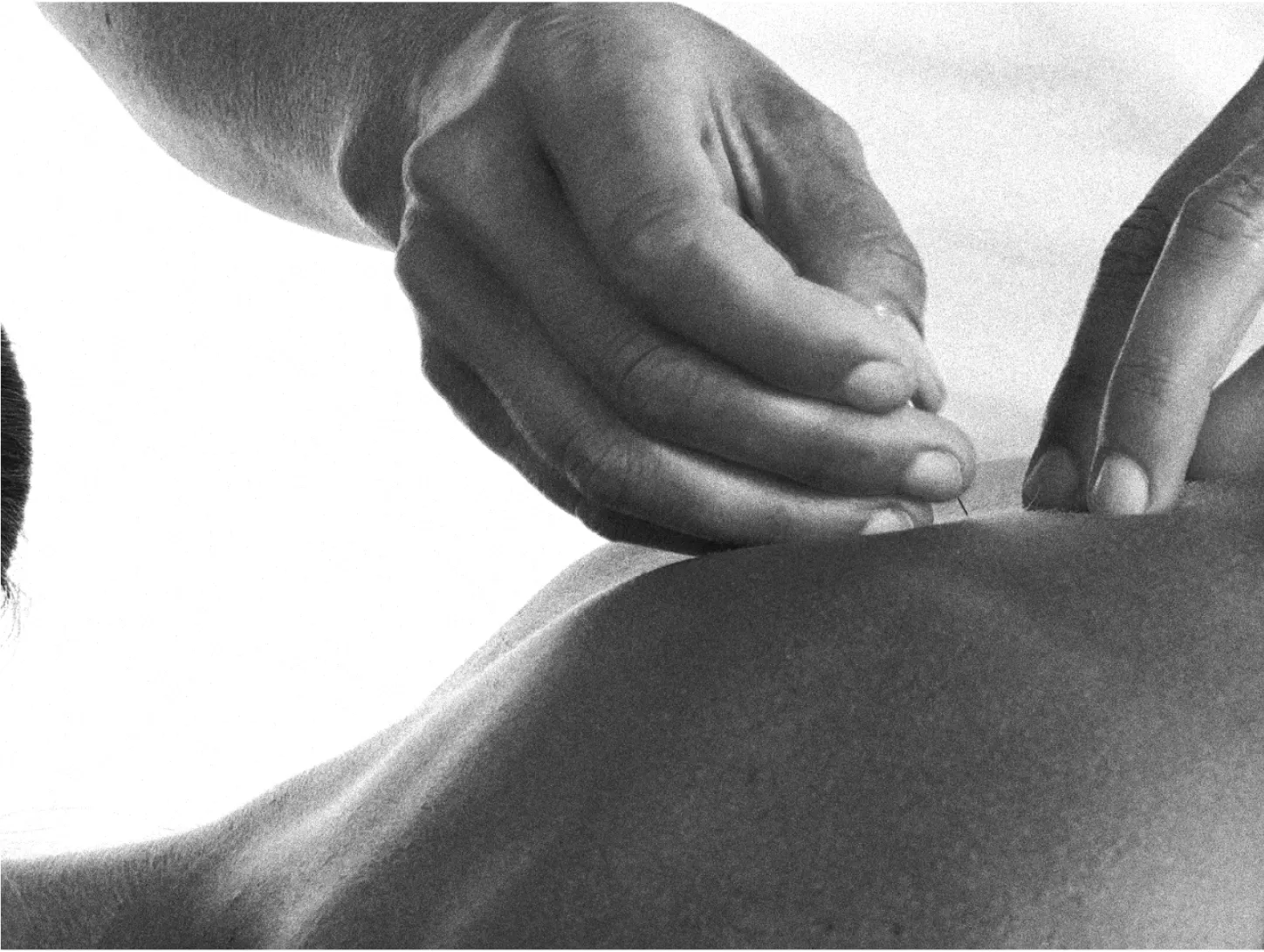 man doing acupuncture on back 