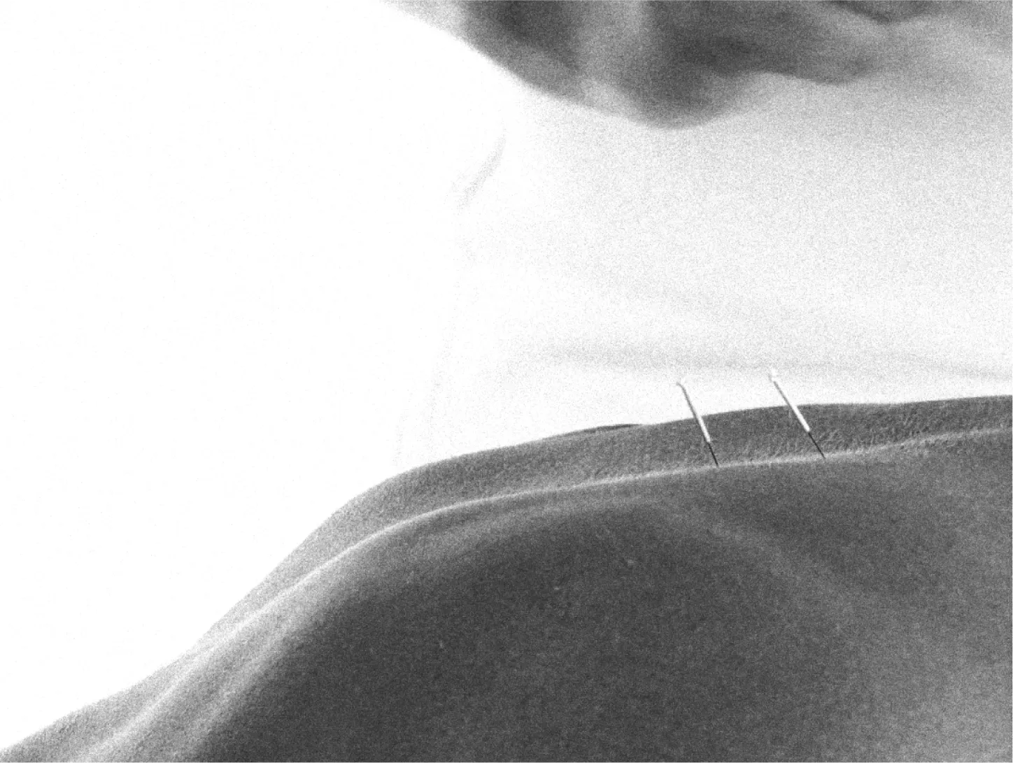 man doing acupuncture on back 