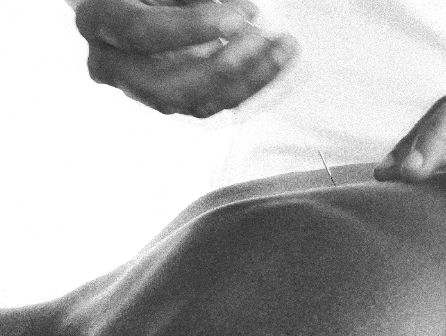 man doing acupuncture on back 