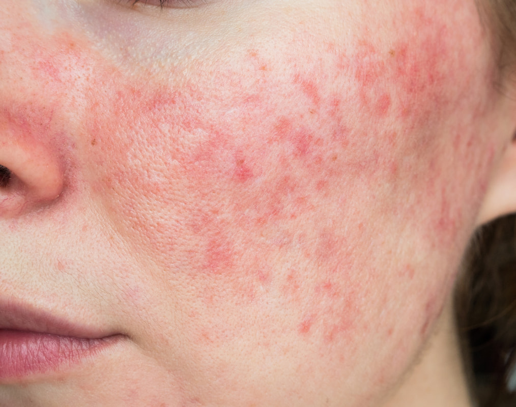 Voorbeeld van rosacea op de huid, vaak verward met acne door roodheid en bultjes.