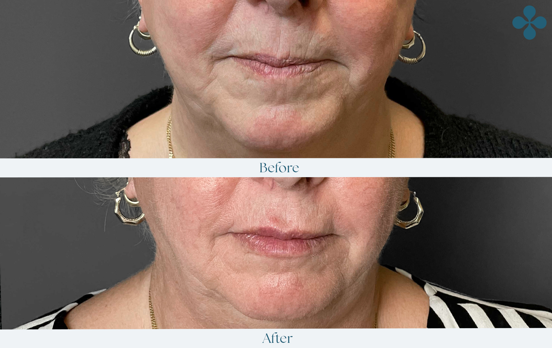Melasma voor 