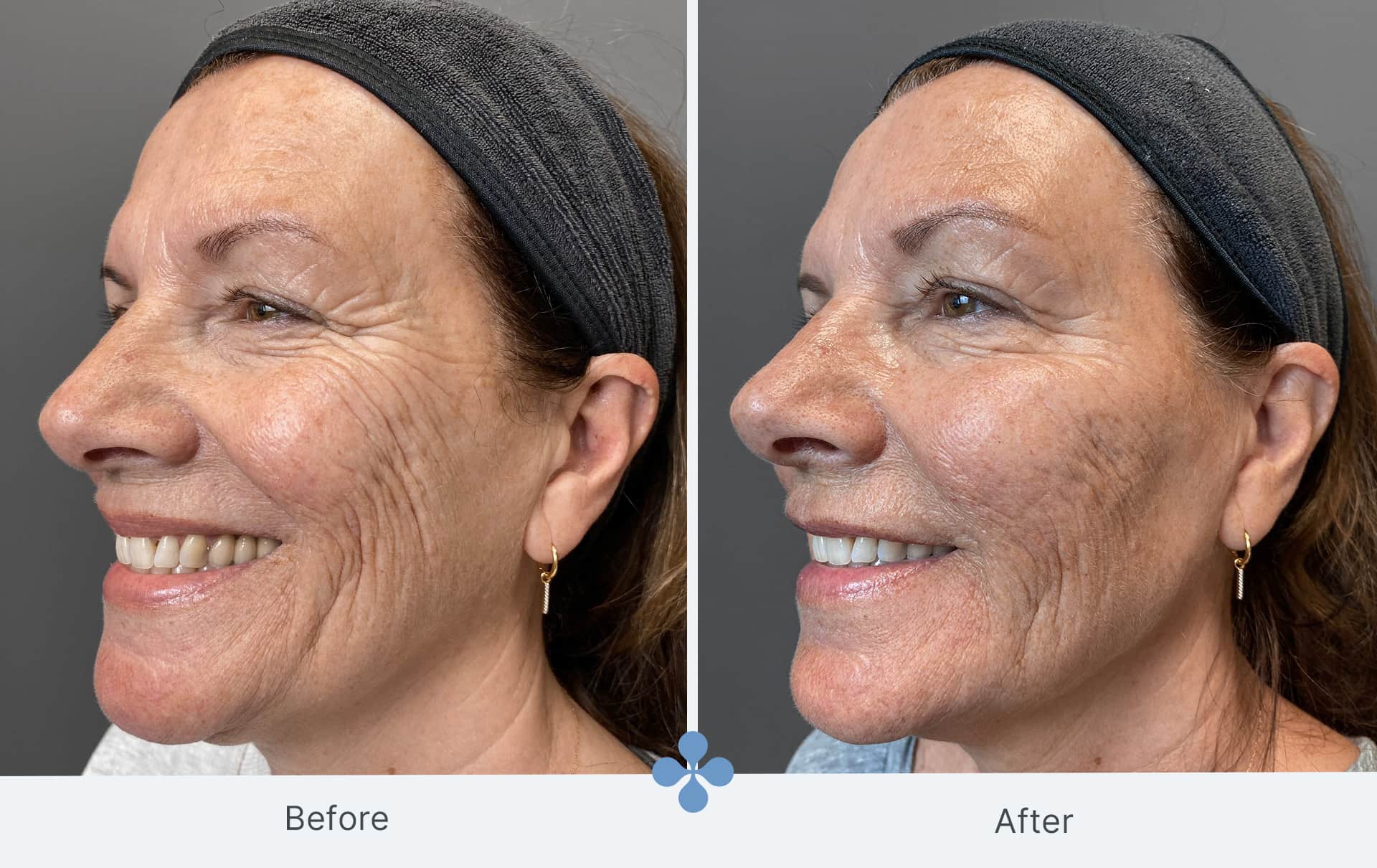 Melasma voor 