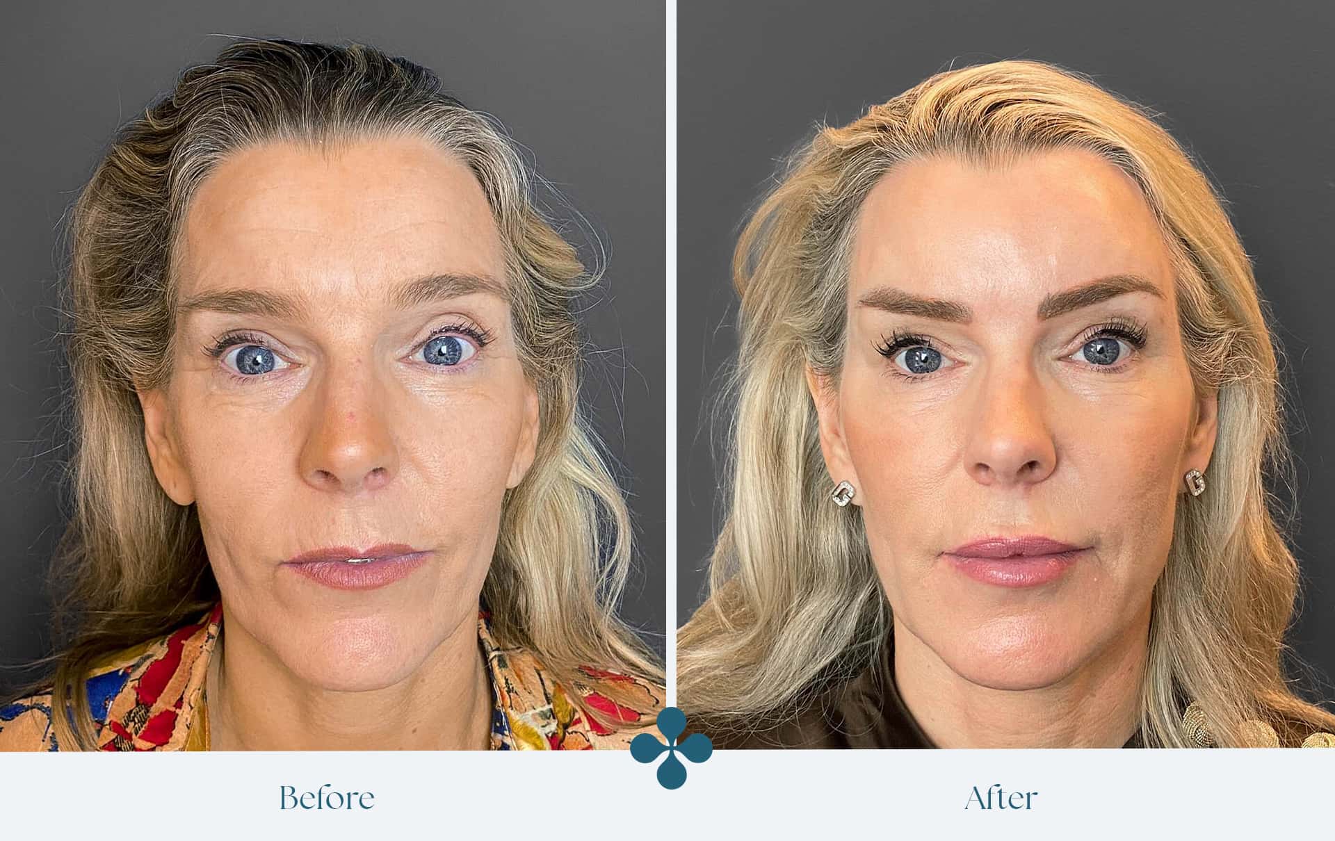 Melasma voor 