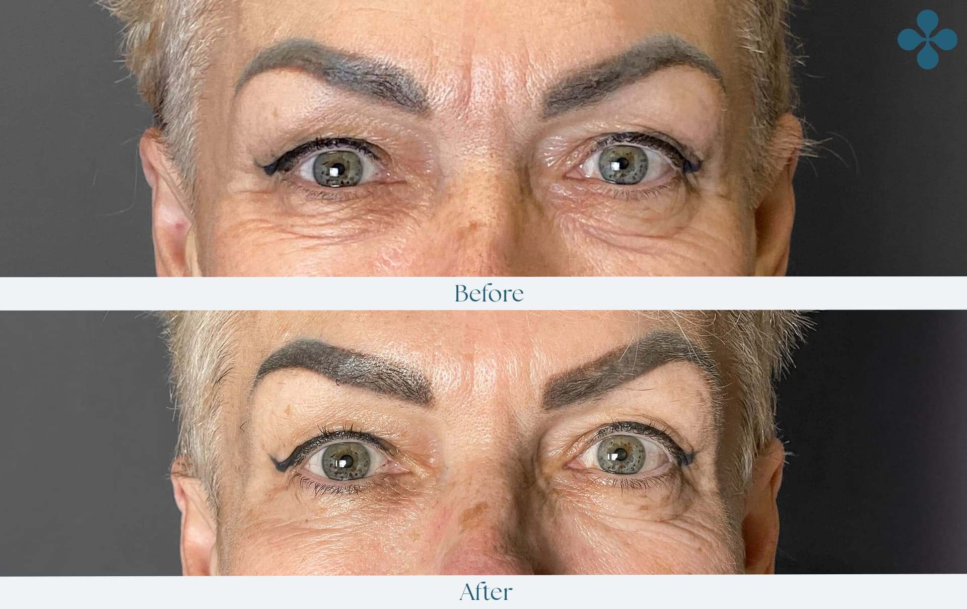 Melasma voor 