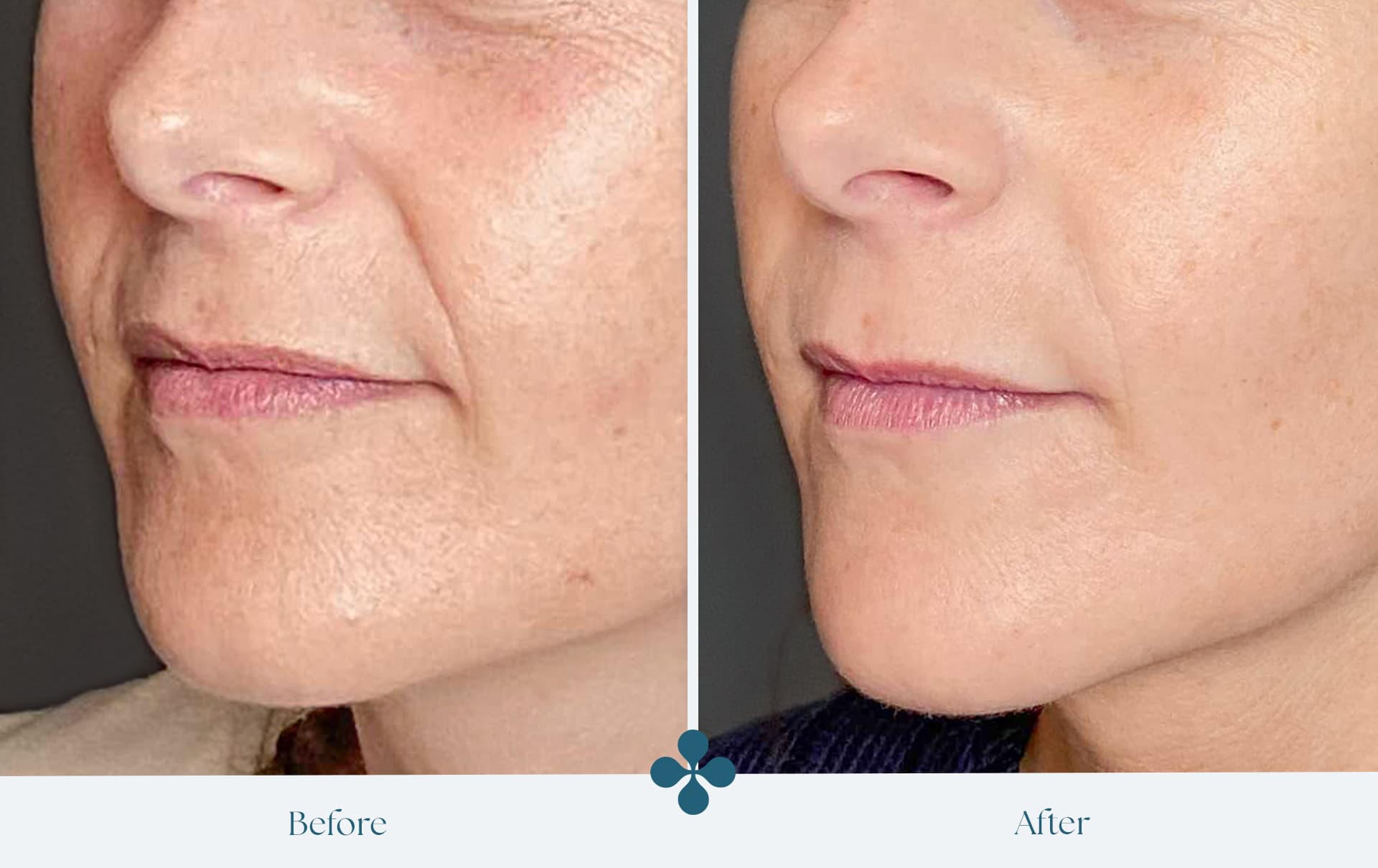 Melasma voor 