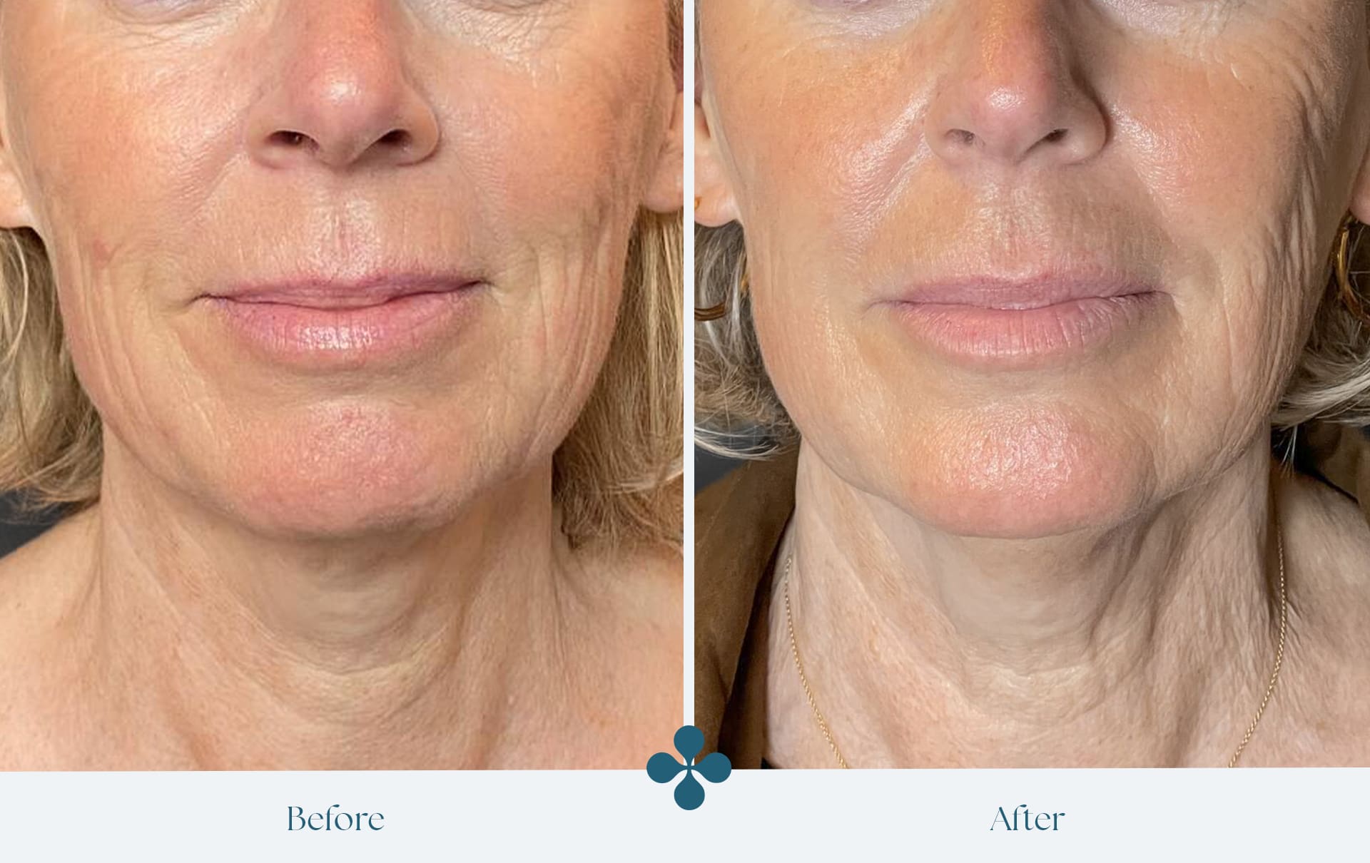 Melasma voor 