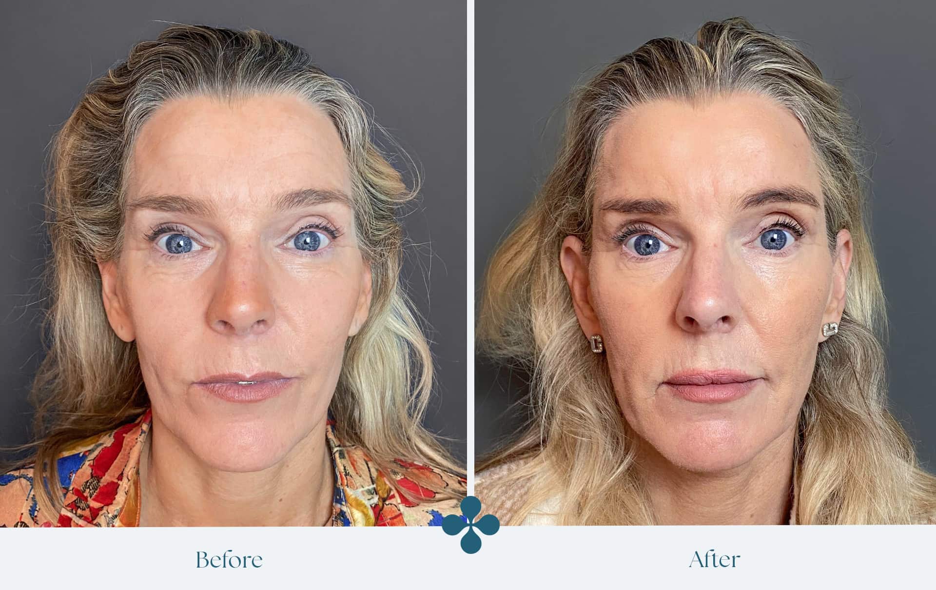 Melasma voor 