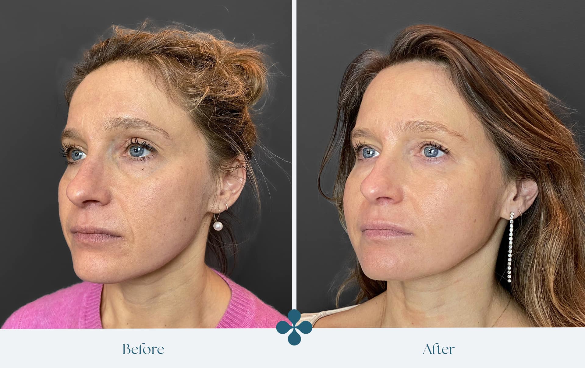 Melasma voor 