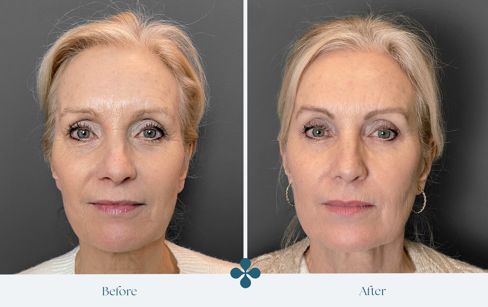 Melasma voor 