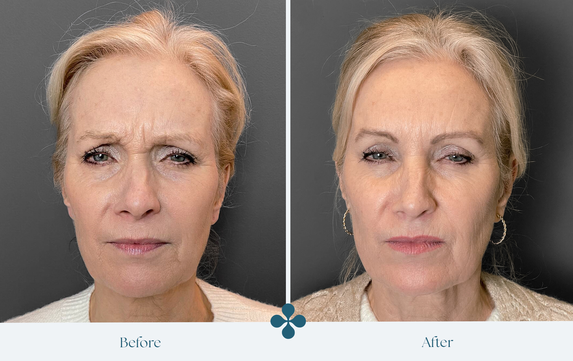 Melasma voor 