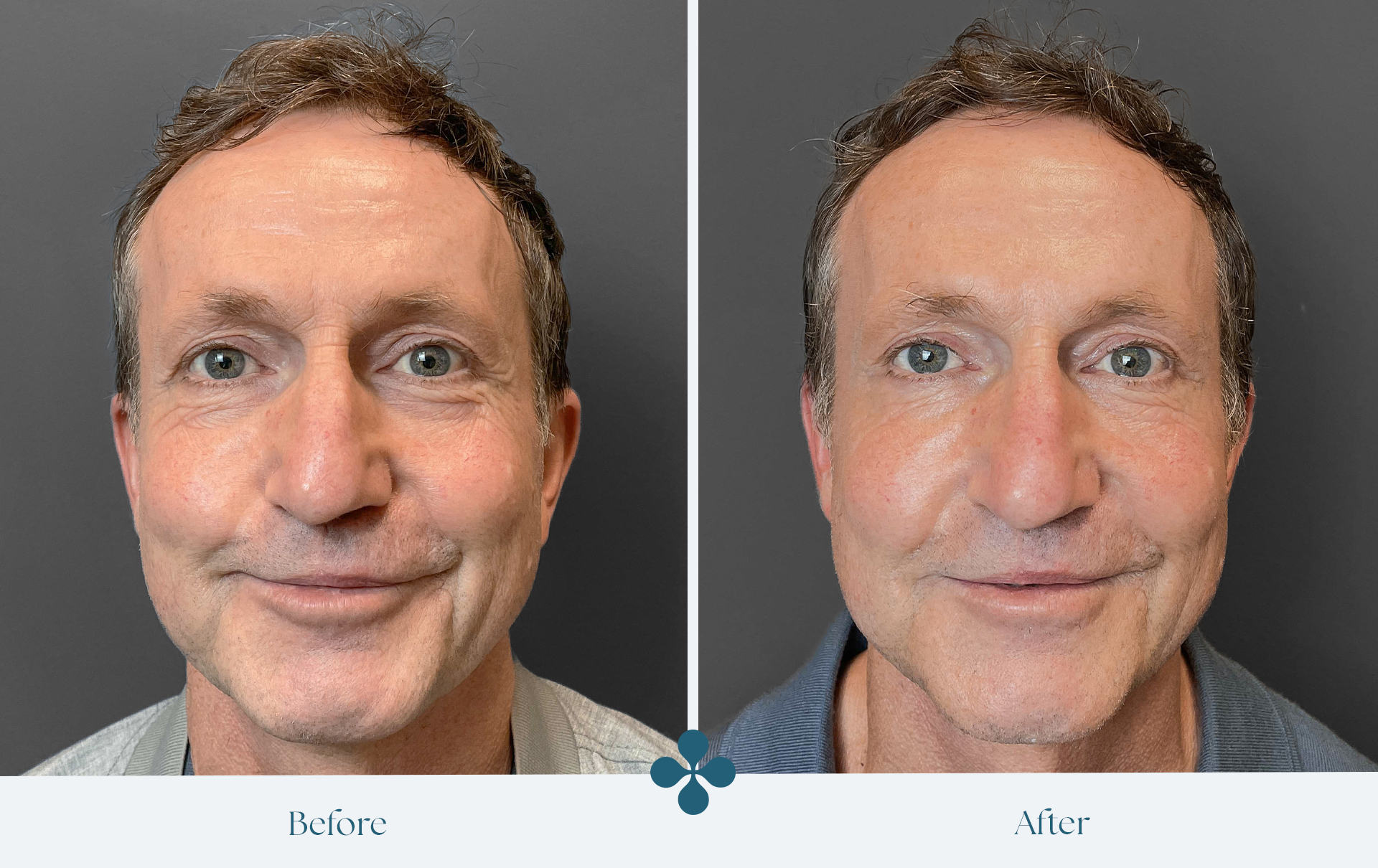 Melasma voor 