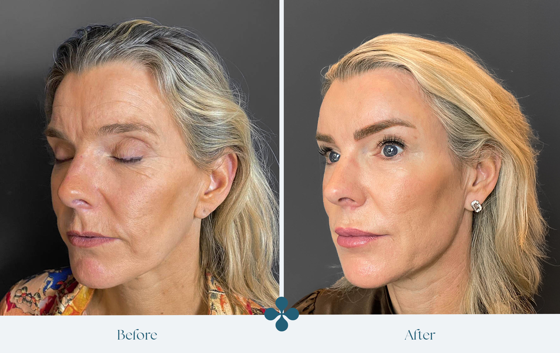 Melasma voor 