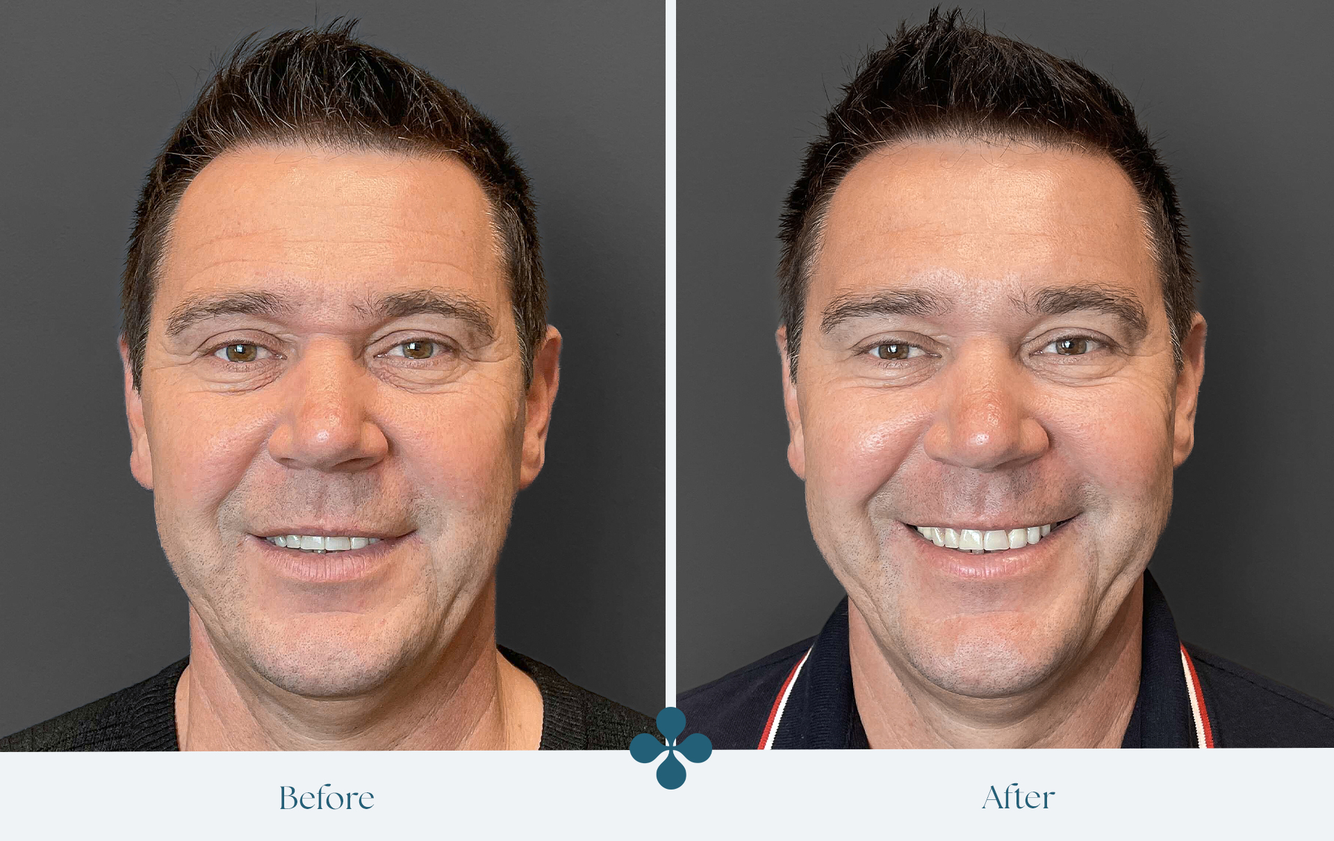 Melasma voor 