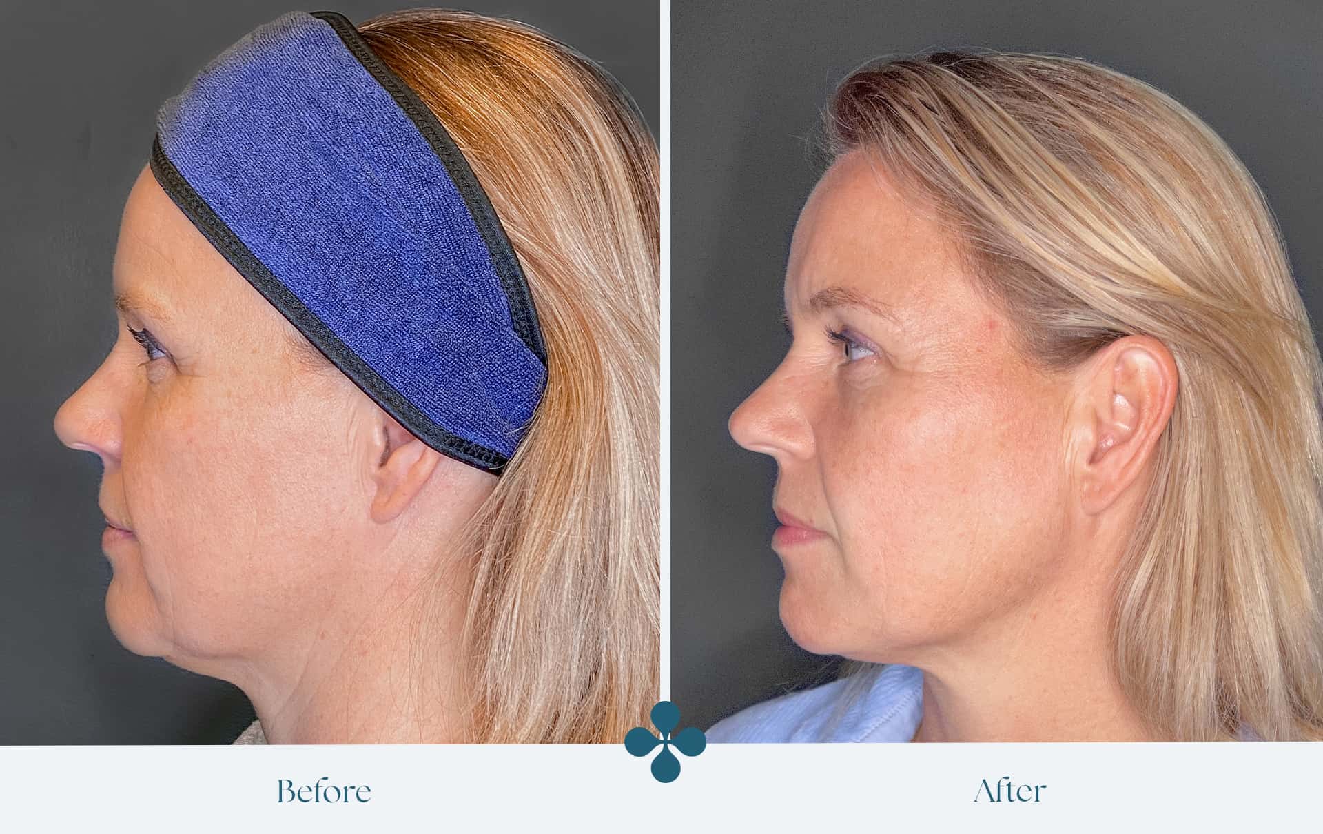 Melasma voor 