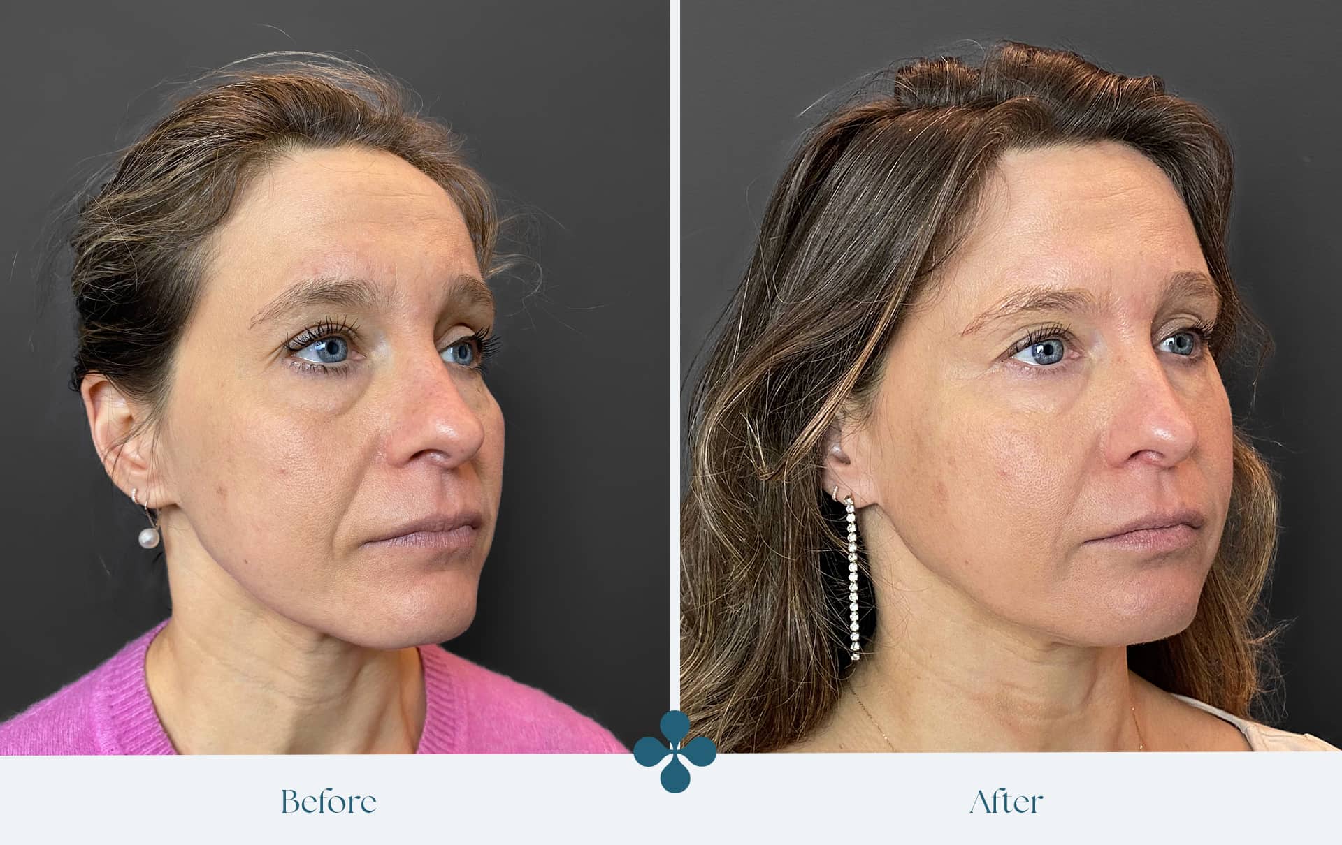 Melasma voor 