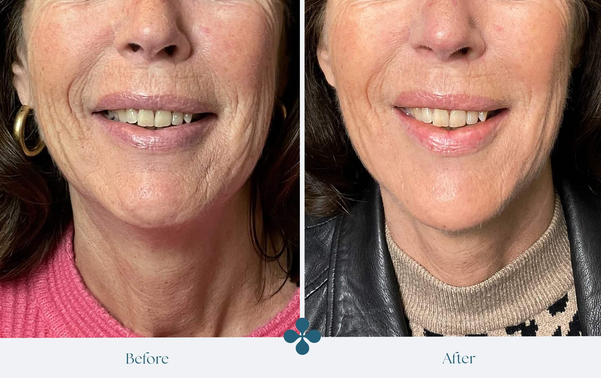 Before and after results at Van Lennep Kliniek