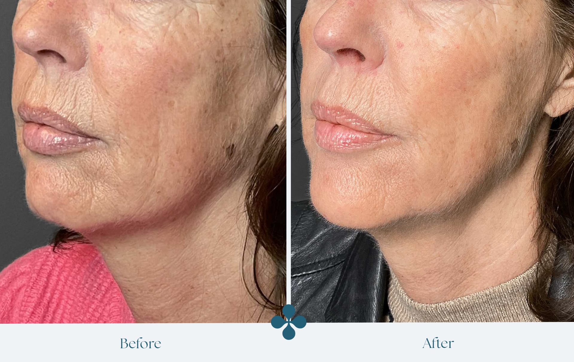 Before and after results at Van Lennep Kliniek