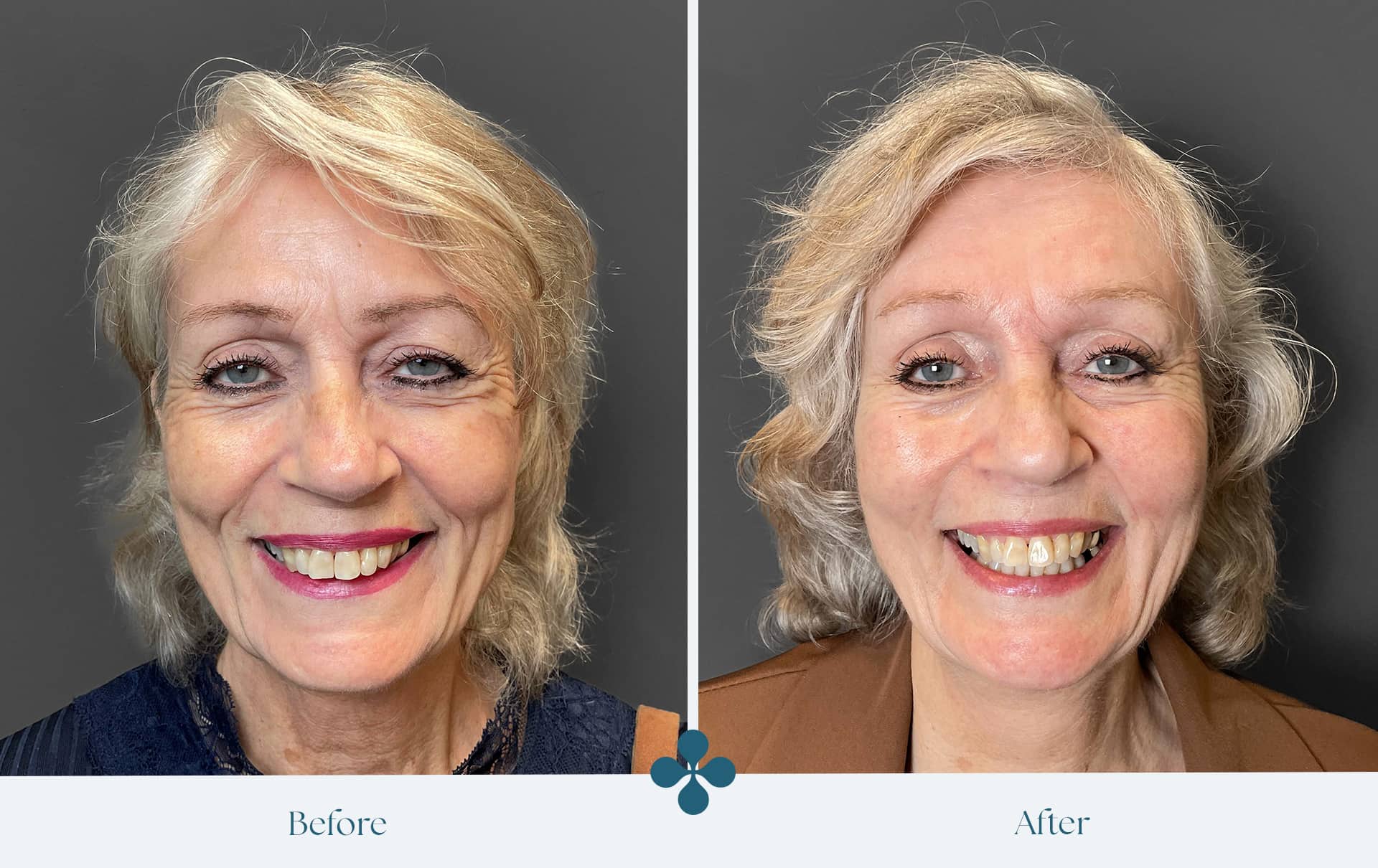 Before and after results at Van Lennep Kliniek