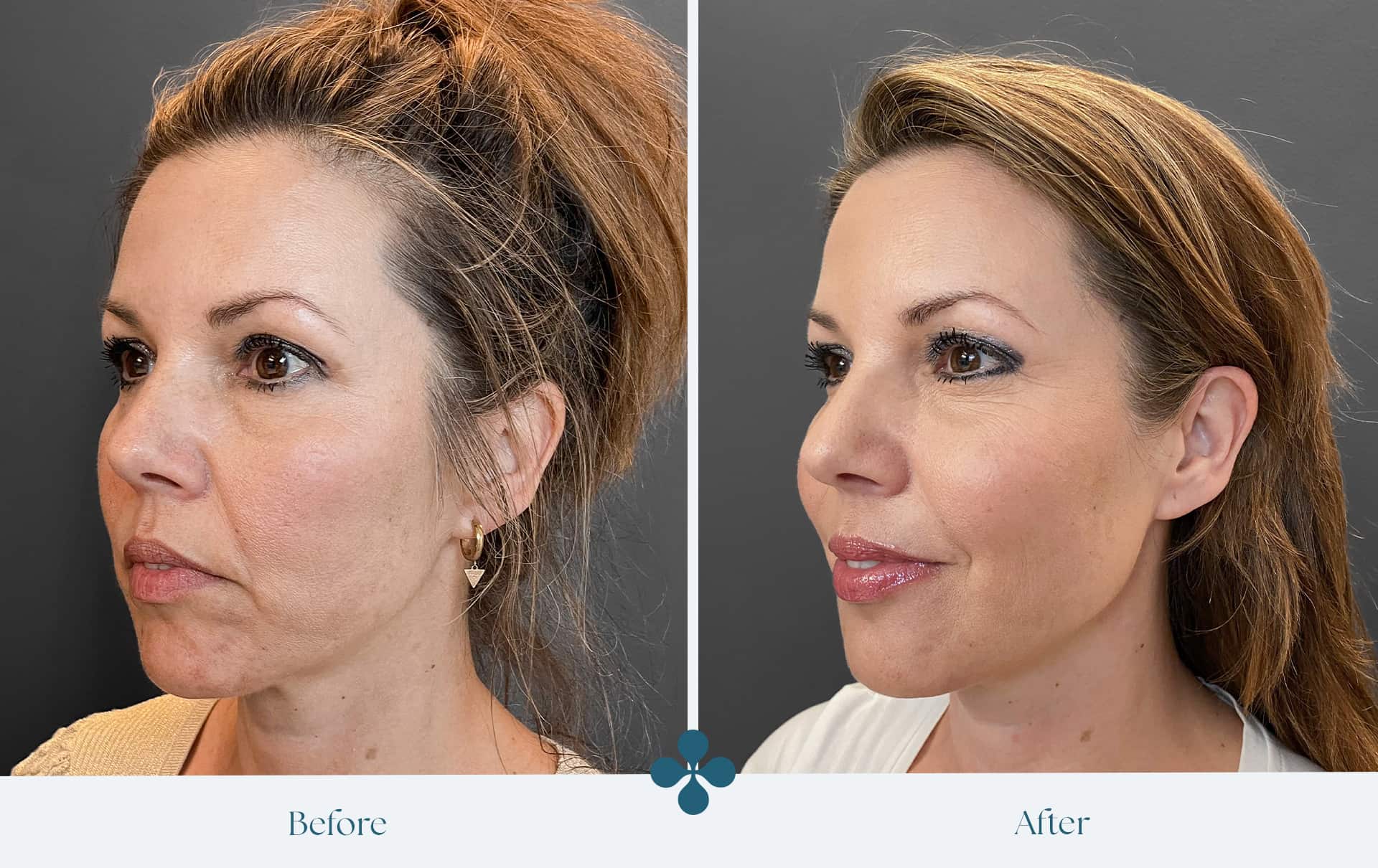 Before and after results at Van Lennep Kliniek