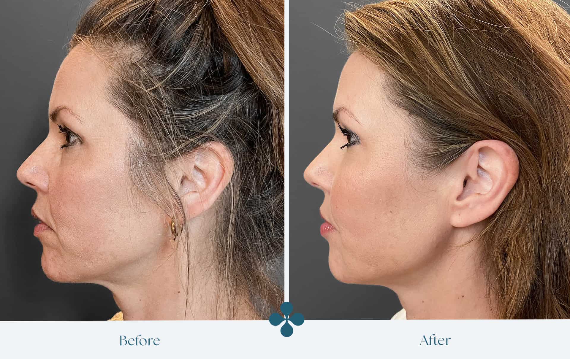Before and after results at Van Lennep Kliniek