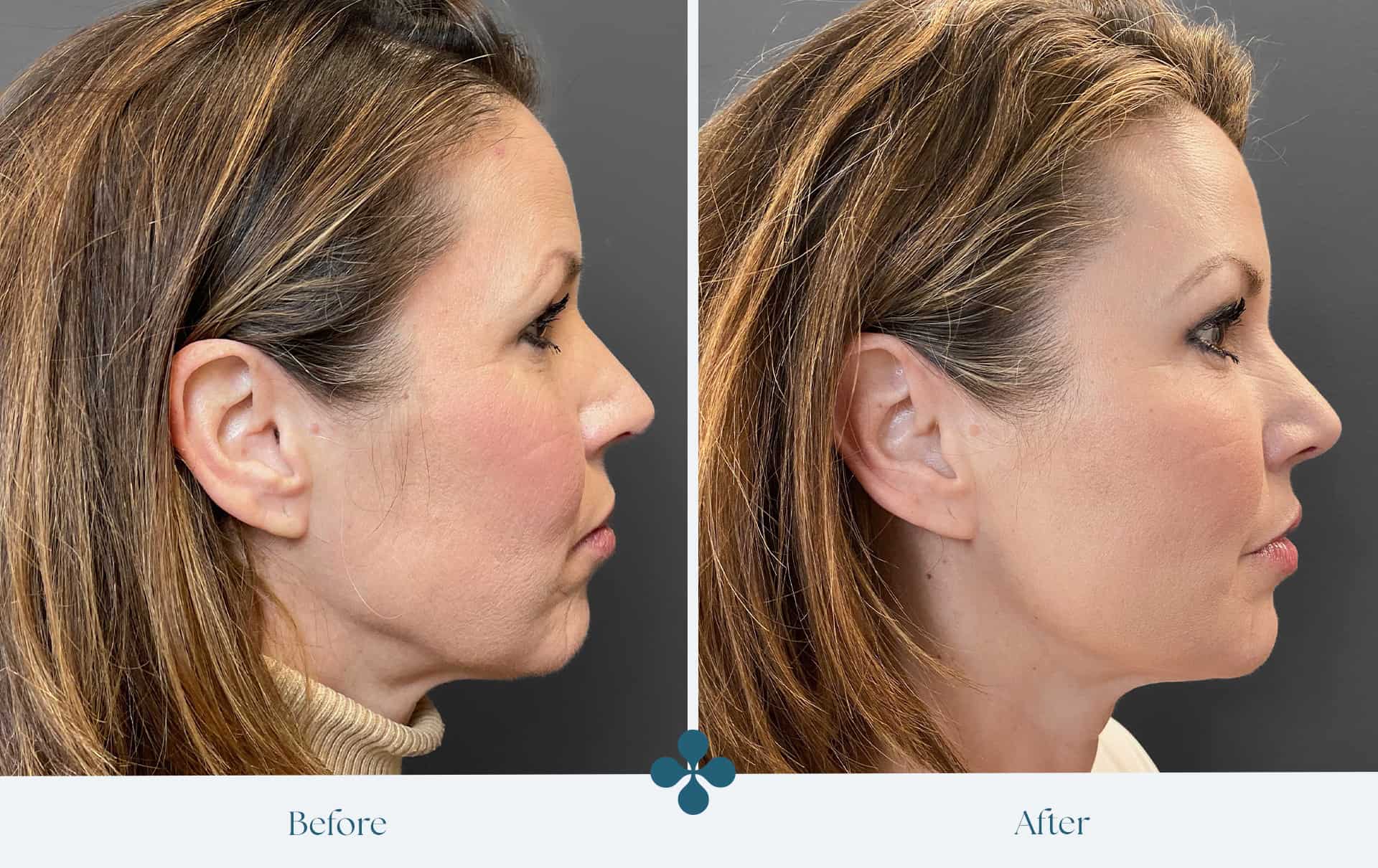 Before and after results at Van Lennep Kliniek