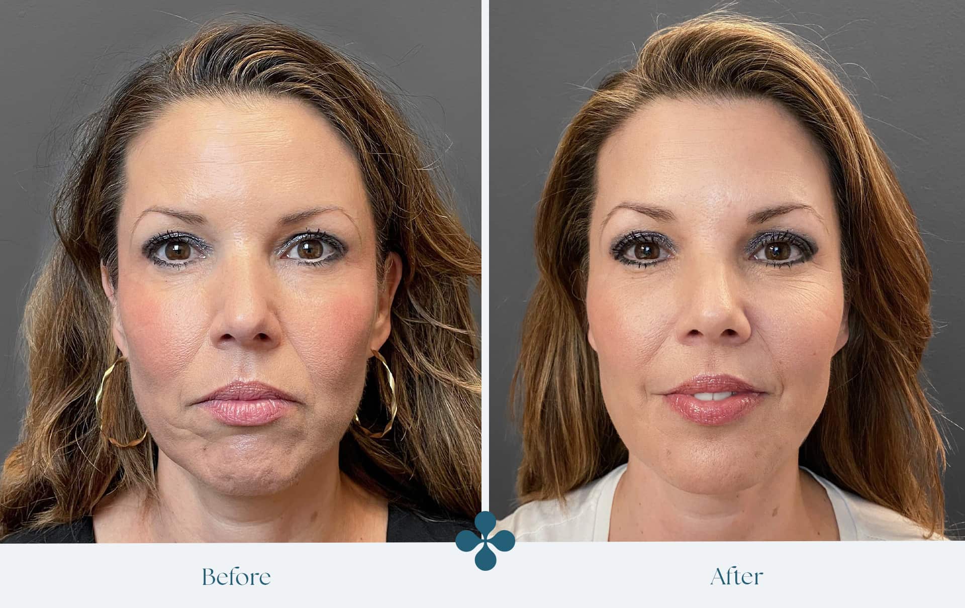 Before and after results at Van Lennep Kliniek