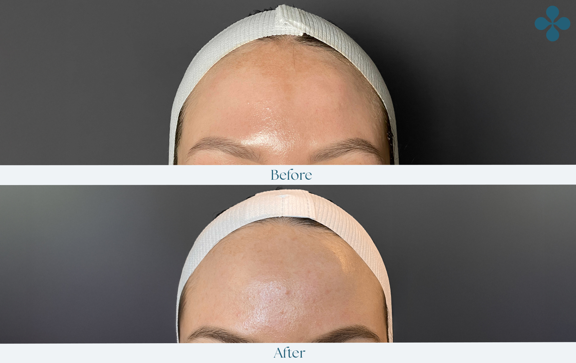 Melasma voor 