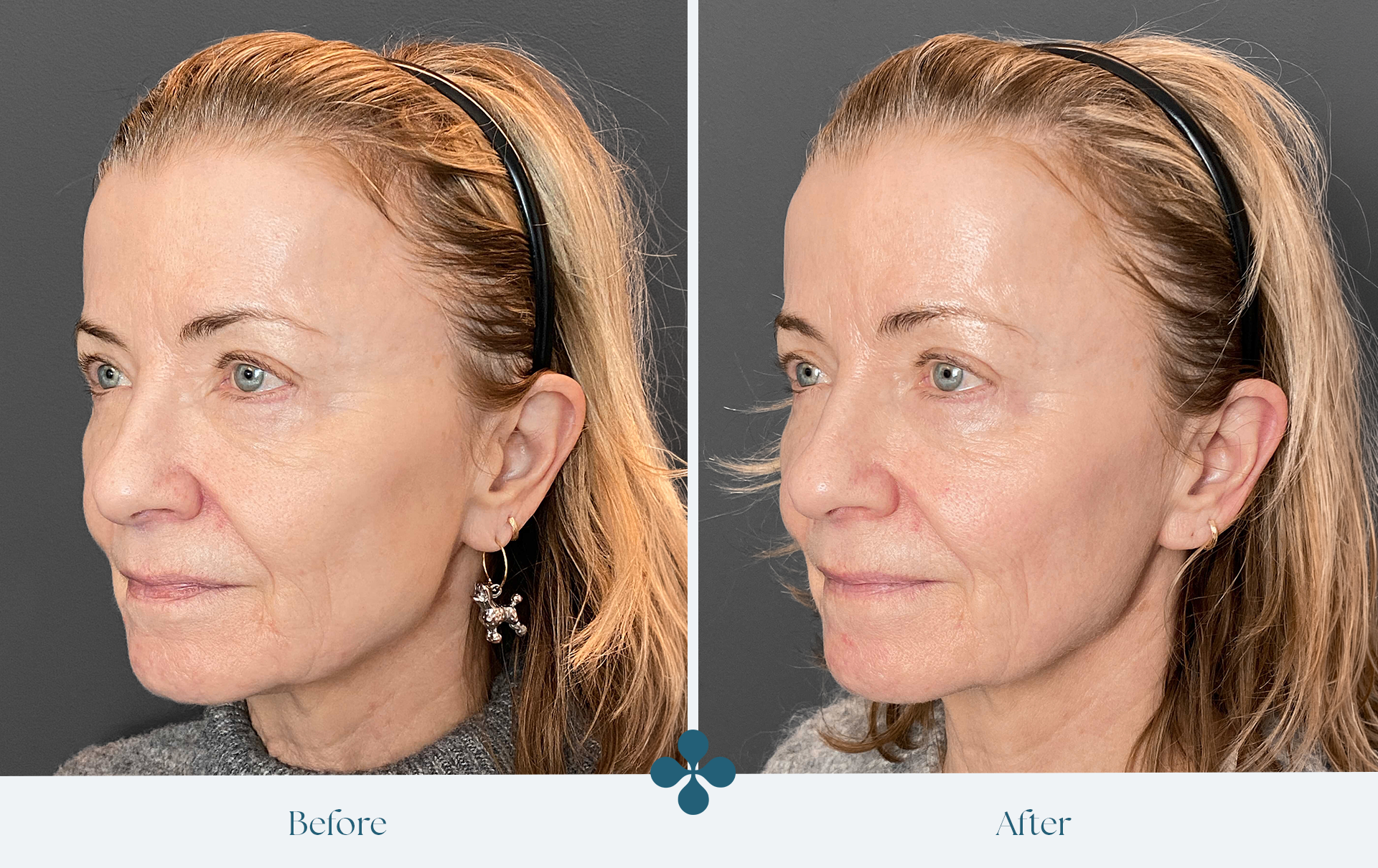 Melasma voor 