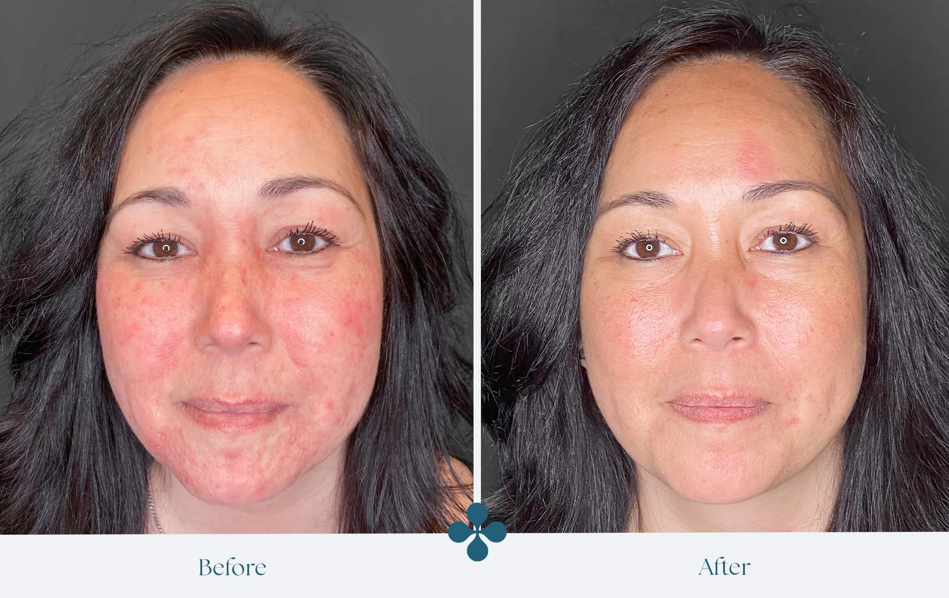 Melasma voor 