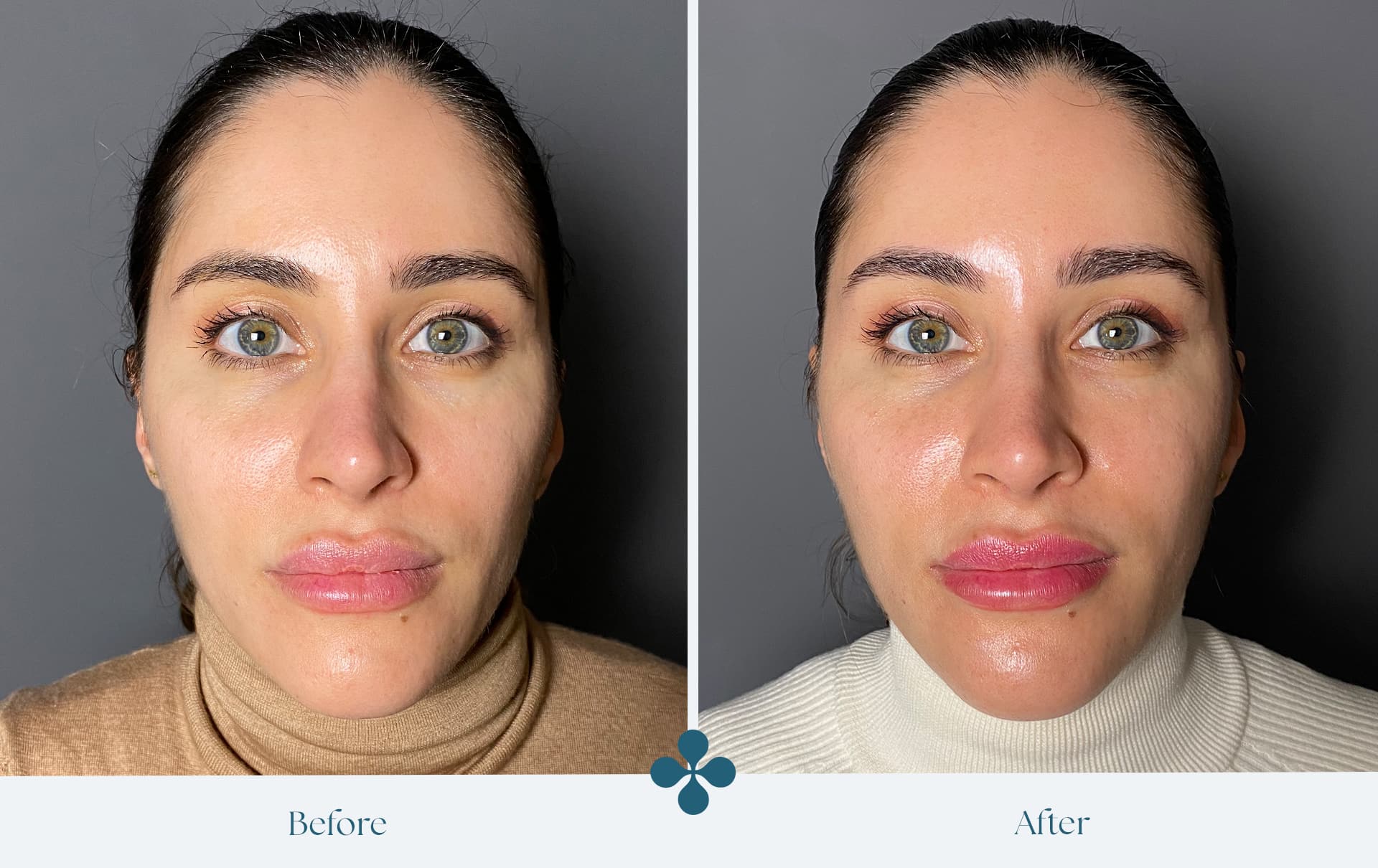 Before and after results at Van Lennep Kliniek