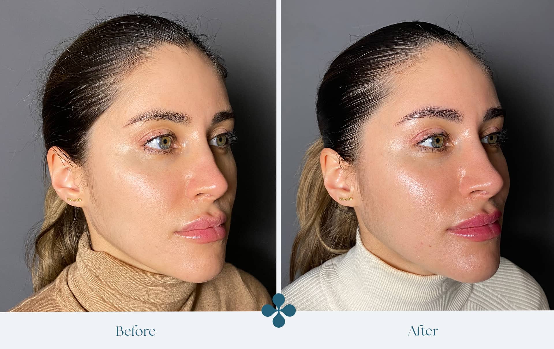 Before and after results at Van Lennep Kliniek