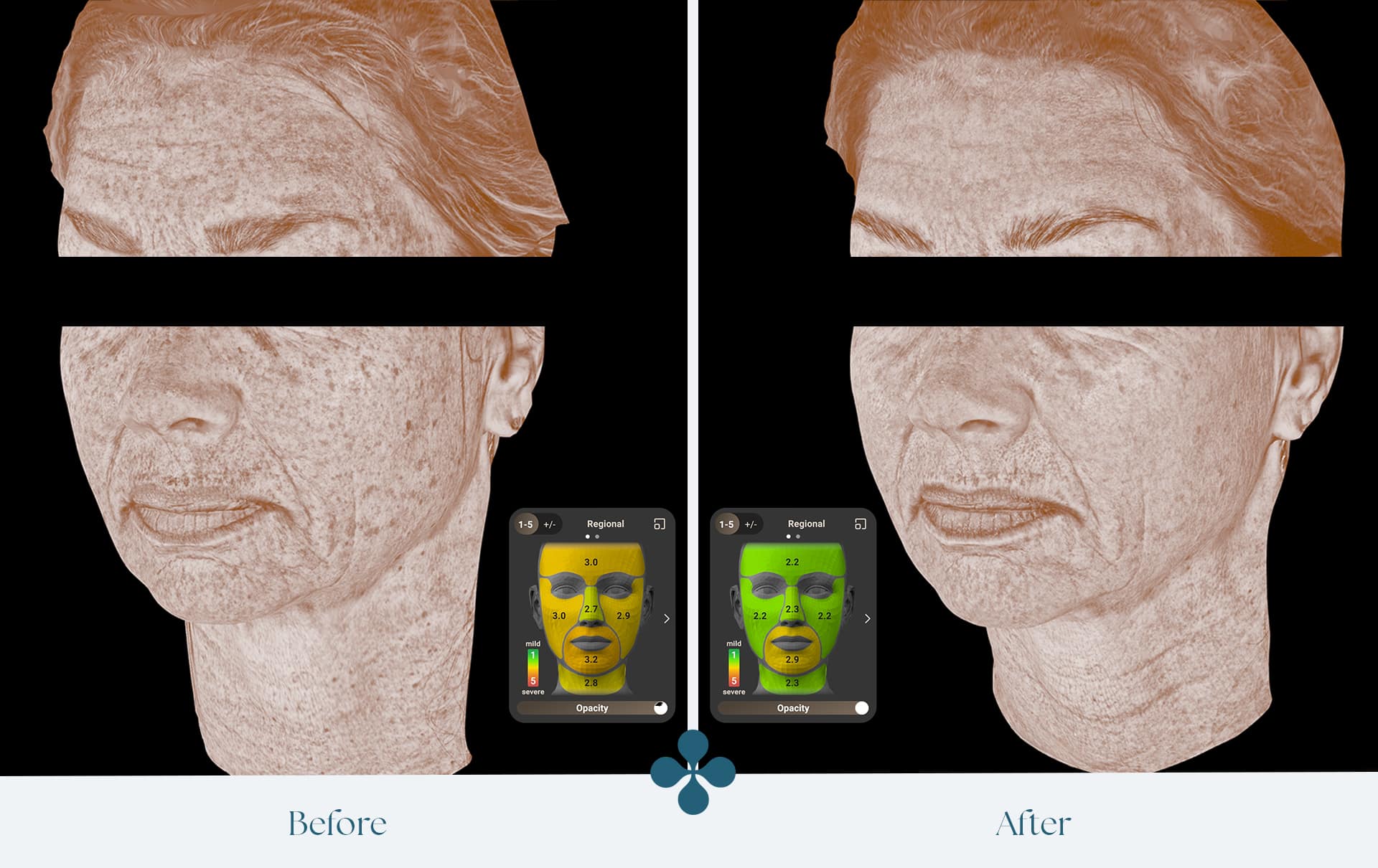 Melasma voor 