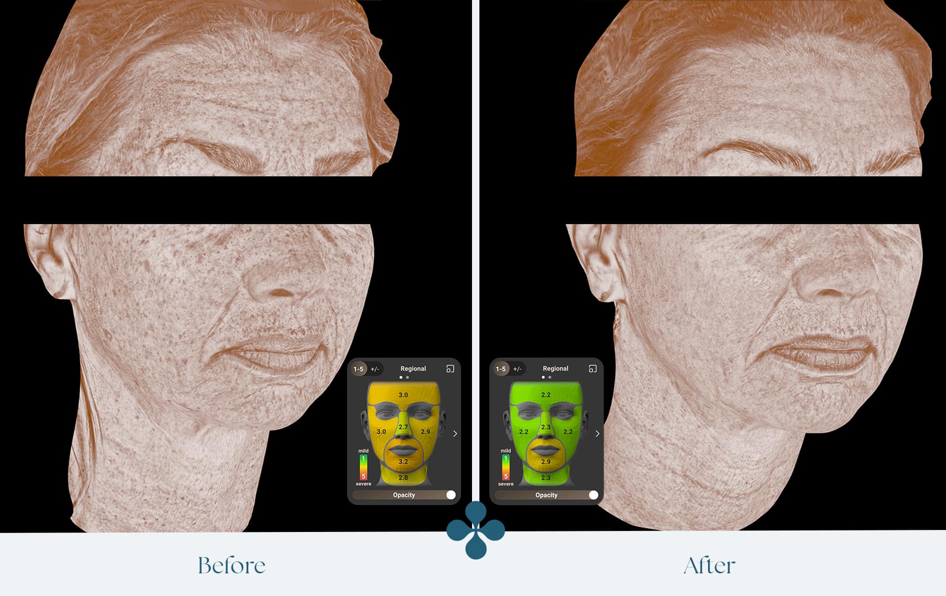 Melasma voor 