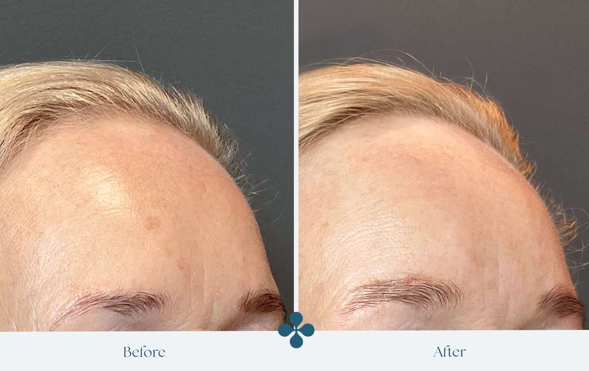 Melasma voor 
