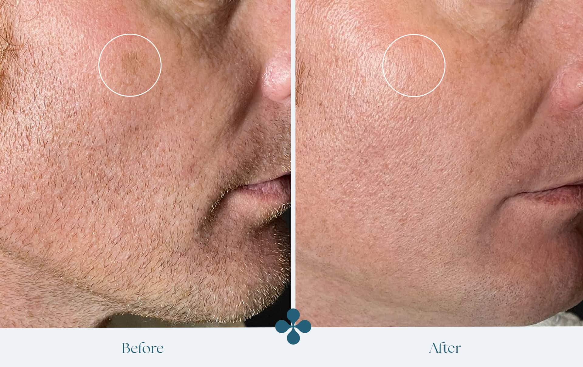 Melasma voor 