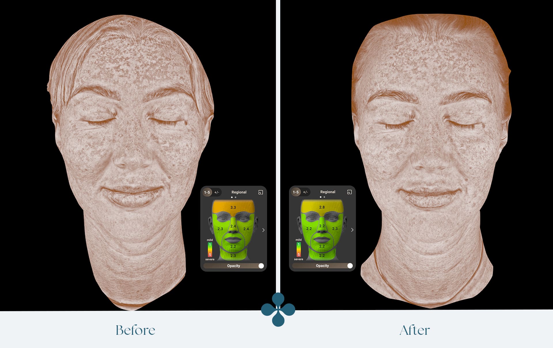 Melasma voor 