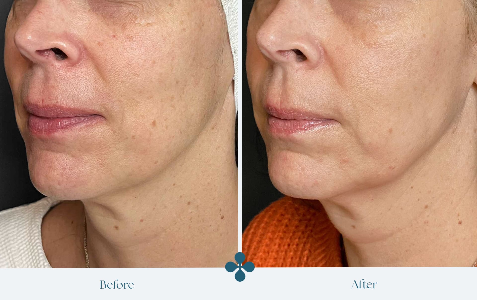 Melasma voor 