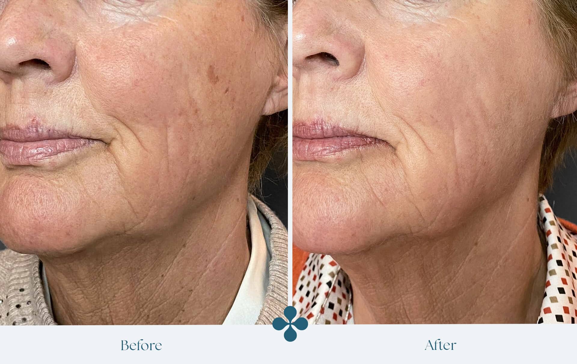 Melasma voor 